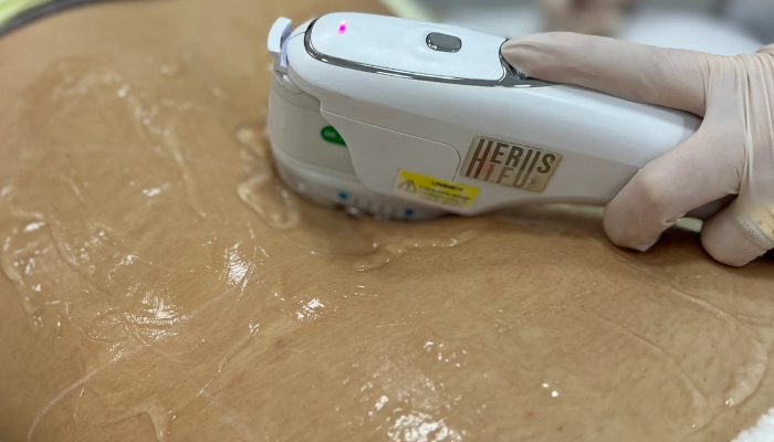 Ultrassom Microfocado Corporal